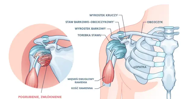 Ilustracja przedstawia zamrożony bark, z pogrubieniem i zwłóknieniem torebki stawu, co powoduje ból barku.