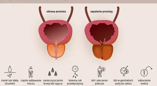 Ilustracja porównuje zdrową prostatę z zapaloną, pokazując objawy zapalenia prostaty: problemy z oddawaniem moczu, ból, pieczenie i zaburzenia erekcji.