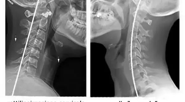 Radiografie del rachide cervicale: a sinistra, rettilineizzazione cervicale con frecce che indicano anomalie; a destra, collo "normale".