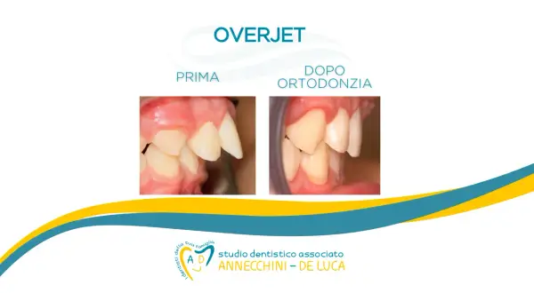 Prima e dopo ortodonzia: denti castoro corretti. Studio dentistico Annecchini - De Luca.