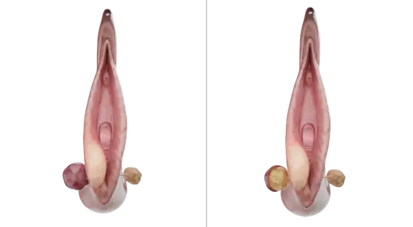 Anatomie féminine montrant une glande de Bartholin enflammée, illustration pour le bartholinite traitement.