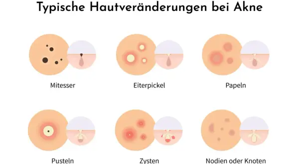 Illustration zeigt typische Hautveränderungen bei Akne: Mitesser, Eiterpickel, Papeln, Pusteln, Zysten und Knoten.