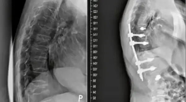 Rentgen kręgosłupa przed i po stabilizacji implantami.