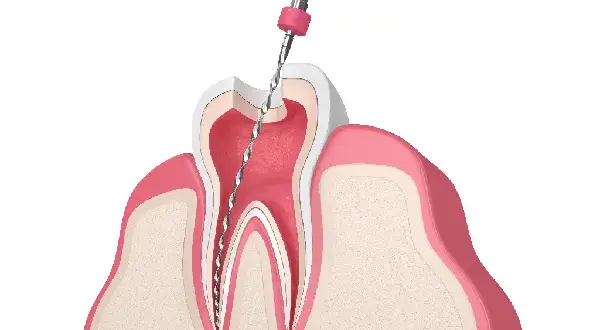 Ból zęba? Sprawdź, czy to leczenie kanałowe i kiedy do dentysty