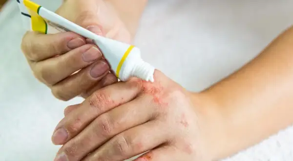 Maść po terminie: groźne skutki! Jak postępować bezpiecznie?