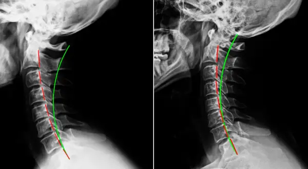 Radiografie cervicali che mostrano una lordosi cervicale ridotta, potenziale causa di vertigini.