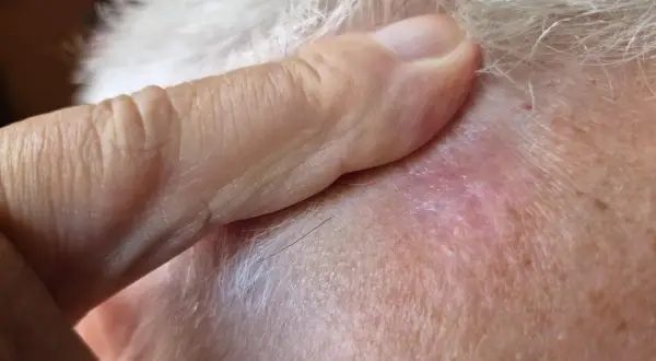 Ein Finger berührt eine gerötete Stelle auf der Kopfhaut, die auf weißen Hautkrebs hindeuten könnte.