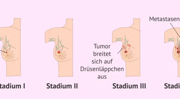 Illustrationen zeigen Stadien von Brustkrebs. Von Stadium I bis IV wächst der Tumor, befällt Lymphknoten und bildet Metastasen. Brustkrebs G3 Erfahrungen sind oft mit fortgeschrittenen Stadien verbunden.