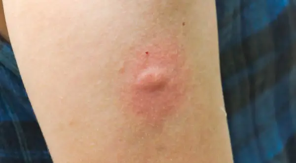Brazo con una picadura hinchada y dura, rodeada de enrojecimiento.