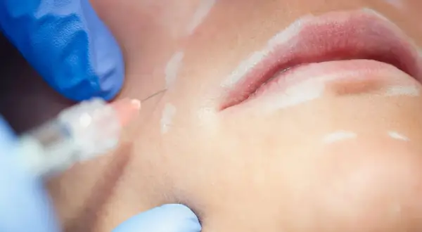 Nahaufnahme einer Lippenunterspritzung. Die Hyaluron-Wirkung sorgt für mehr Volumen und eine jugendlichere Ausstrahlung.