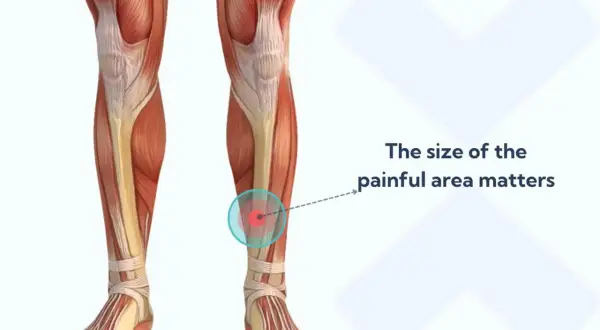 Anatomia della gamba con evidenziato il dolore tibiale anteriore camminare. L'area dolorante è indicata da cerchi concentrici.