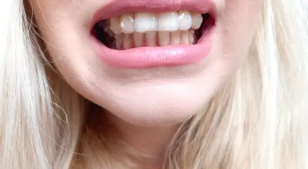 Uśmiech z dyskretnymi nakładkami Invisalign, które korygują zęby. Jasne włosy i różowe usta dopełniają całość.