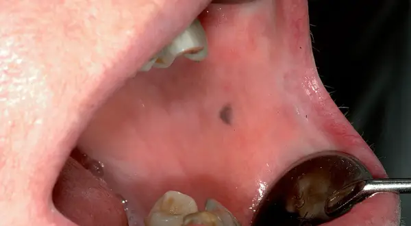 Piccolo neo scuro, una lesione mucosa geniena, visibile all'interno della bocca, vicino ai denti.