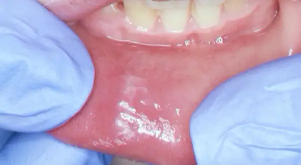 Dita guantate espongono la mucosa orale, rivelando una macchia bianca sul labbro inferiore, forse un segno di irritazione.