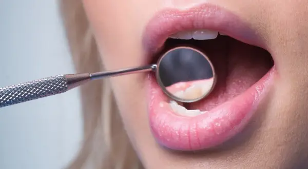 Usta kobiety z lusterkiem dentystycznym badającym zęby, uwidaczniające początki demineralizacji szkliwa.