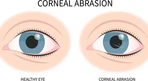 Ilustracja porównująca zdrowe oko z okiem z otarciem rogówki, widoczne drobne zadrapanie na rogówce.