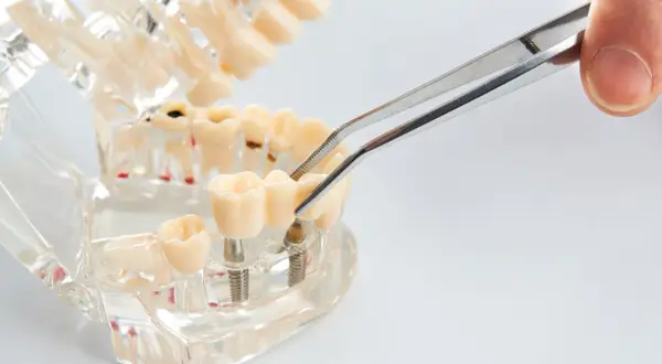 Model szczęki z implantami zębów, gdzie pęseta manipuluje ruszającym się implantem zęba, pokazując jego stabilność.