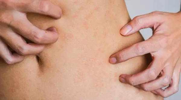 Zaburzenia hormonalne objawy skórne: co może oznaczać Twoja skóra?