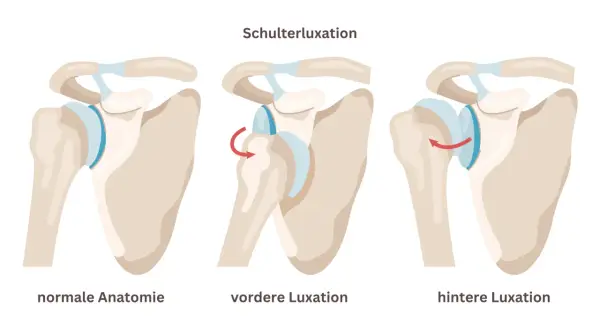 Schulterluxation: normale Anatomie, vordere Luxation (Rotationspfeil) und hintere Luxation (Rotationspfeil). Eine latarjet op kann bei wiederholten Luxationen helfen.