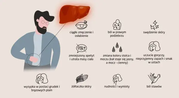 Ilustracja przedstawia objawy chorób wątroby, w tym zmęczenie, ból brzucha, swędzenie skóry, nudności, żółtaczkę, a także zmiany w kolorze moczu i stolca. Wzw c może objawiać się podobnymi symptomami.