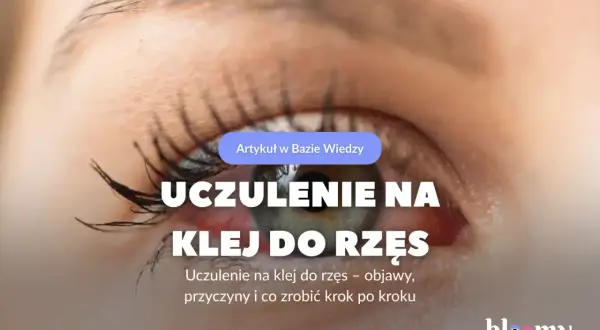 Czerwone, podrażnione oko z widocznym uczuleniem na klej do rzęs. Artykuł omawia objawy i przyczyny.