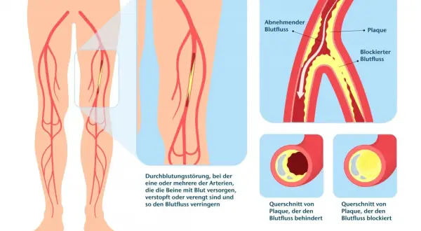 Illustration zeigt PAVK: Plaque verengt Arterien im Bein, behindert Blutfluss. Gehtraining kann helfen.