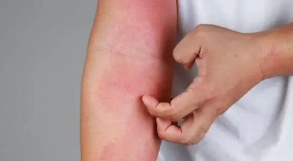 Alergia na leki objawy – jak rozpoznać groźne reakcje alergiczne