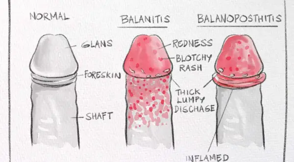 Ilustracja porównuje normalnego penisa z balanitis i balanoposthitis, pokazując objawy takie jak zaczerwienienie i wydzielina. Zrozumienie, smegma co to, jest kluczowe dla higieny.