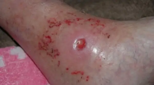 Hautirritation mit Rötung und kleinen Wunden, möglicherweise eine panthenol allergie.