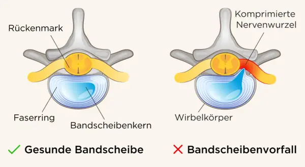 Vergleich einer gesunden Bandscheibe mit einem Bandscheibenvorfall, der eine Nervenwurzel komprimiert und so Symptome verursacht.