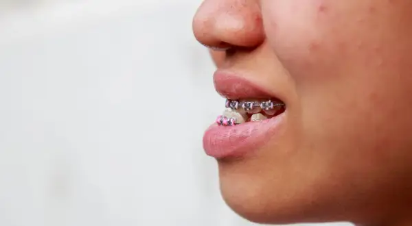 Primo piano di una bocca con apparecchio ortodontico, la **mandibola in avanti** per mostrare i denti allineati.