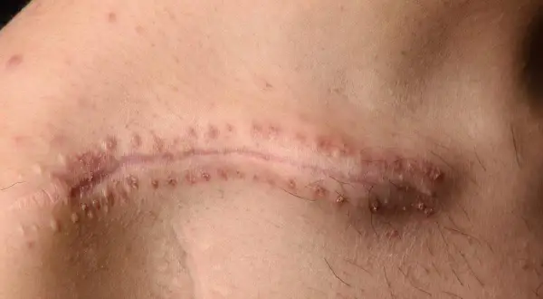 Cicatrice chirurgicale avec des points rouges, comme un fil résorbable qui ne se résorbe pas, sur une peau claire.