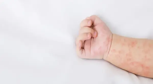 Ręka niemowlaka z zaczerwienioną wysypką. Skóra pokryta jest drobnymi, różowymi plamkami, które mogą świadczyć o alergii lub chorobie.