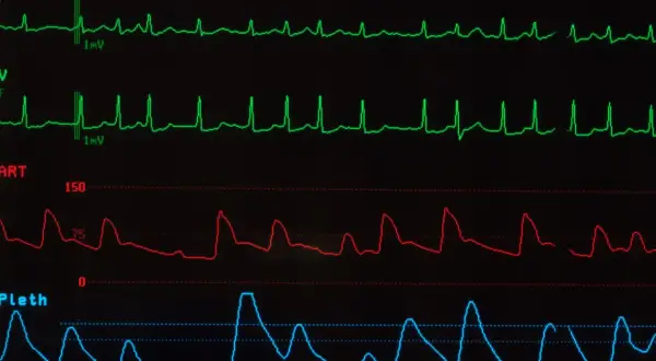 Monitor EKG pokazuje nieregularne fale, sugerujące migotanie przedsionków. Widoczne są również linie ciśnienia krwi i pulsoksymetrii.