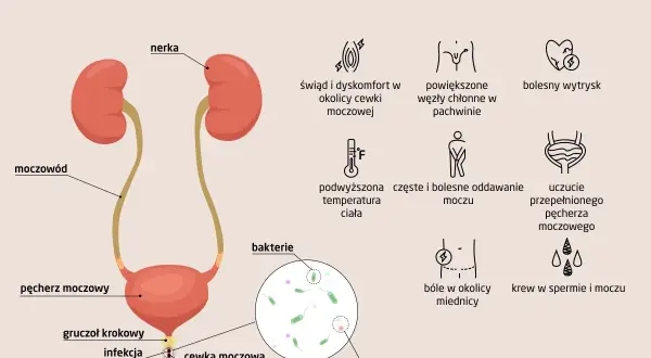 Objawy zapalenia cewki moczowej: świąd, ból, gorączka, krew w moczu, bolesne oddawanie moczu. Ilustracja układu moczowego i objawów.
