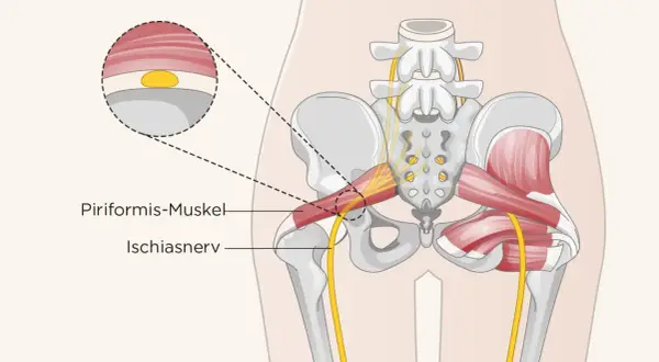 Der musculus piriformis im Beckenbereich, daneben der Ischiasnerv. Eine Nahaufnahme zeigt die Muskelfaserstruktur.