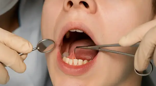 Zabieg podcięcia wędzidełka u dorosłego. Dentysta używa pęsety i lusterka do precyzyjnego wykonania procedury.
