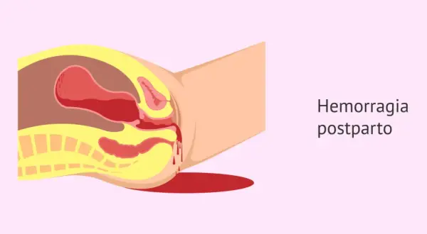 Ilustración anatómica que muestra los tipos de sangrado postparto, con sangre saliendo del útero y la vagina.