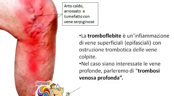 Gamba con arrossamento e vene gonfie, indicativo di un calore improvviso alle gambe.