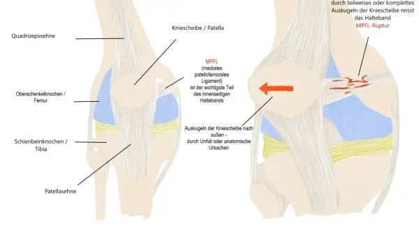 Anatomische Darstellung eines Knies, die zeigt, wie das MPFL-Band bei einer Ausrenkung der Kniescheibe reißen kann (MPFL-Ruptur).