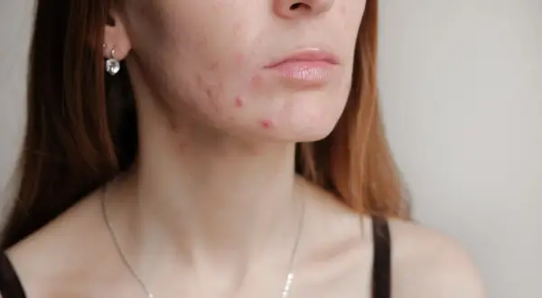 Hautunreinheiten im Gesicht und am Hals, möglicherweise nach dem Absetzen der Pille. Rote Pickel und Mitesser sind sichtbar.