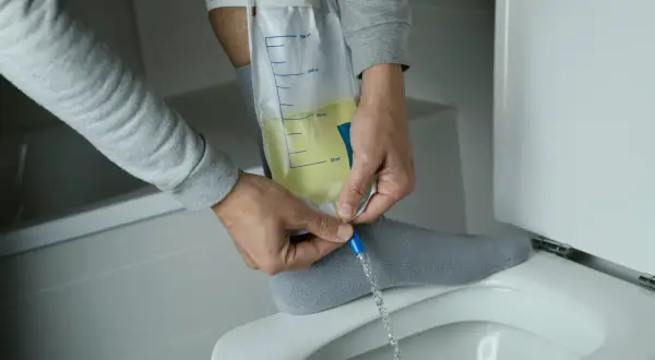 Mann entleert Urinbeutel, der mit einem Bauchdeckenkatheter verbunden ist. Erfahrungen damit sind oft eine Umstellung.