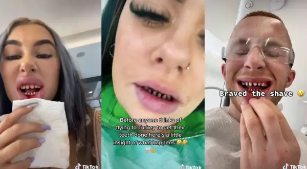 Trzy osoby pokazują swoje zęby po zabiegu stomatologicznym w Turcji. Jedna z nich trzyma chusteczkę, druga ma napis "Braved the shave".