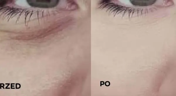 Przed i po: jak dbać o skórę pod oczami, by była gładka i wypoczęta. Widoczne wygładzenie zmarszczek.