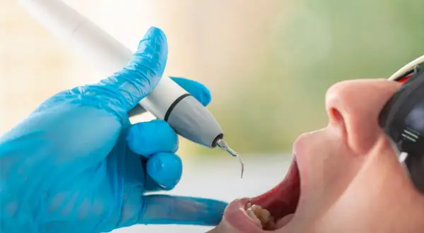 Dentysta usuwa kamień z zębów pacjenta. Czy usuwanie kamienia boli? Nowoczesne metody są zazwyczaj bezbolesne.