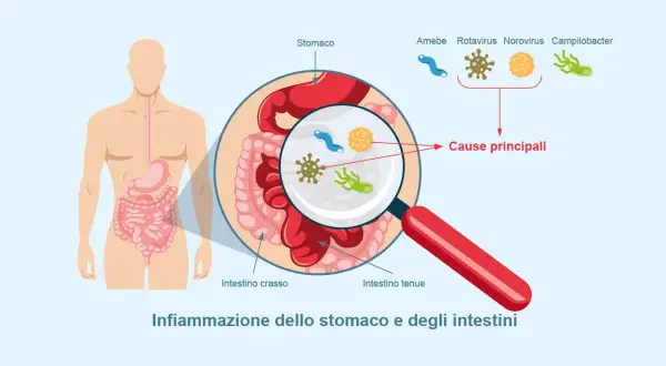 Illustrazione dell'apparato digerente con ingrandimento che mostra i microrganismi causa di gastroenterite sintomi.
