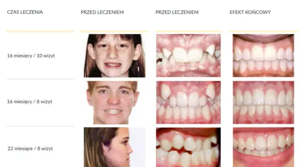 Aparat na zęby: Jak działa, etapy leczenia i ile kosztuje?