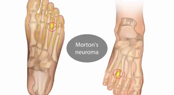 Illustrazione anatomica del piede che mostra un neuroma di Morton, una condizione che rende doloroso il camminare.