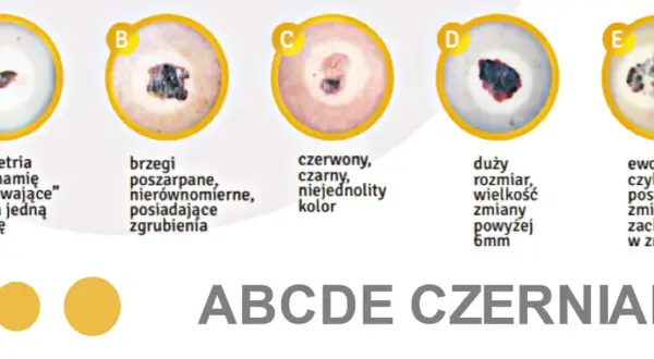 ABCDE czerniaka: asymetria, brzegi, kolor, duży rozmiar, ewolucja. Zmiany na ustach mogą być niepokojące.