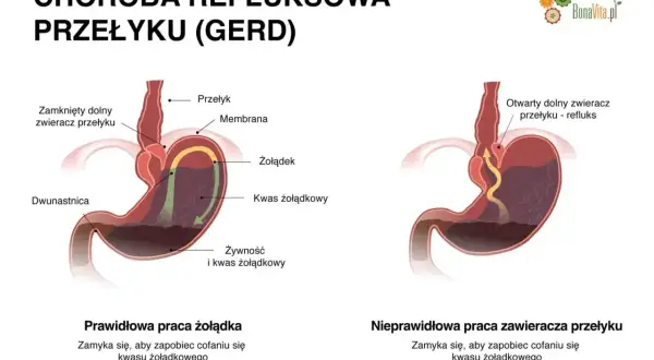 Ilustracja pokazuje prawidłowe i nieprawidłowe działanie zwieracza przełyku, wyjaśniając problem refluksu żołądka.